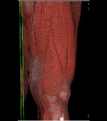 Abscess Thigh - CTisus CT Scan