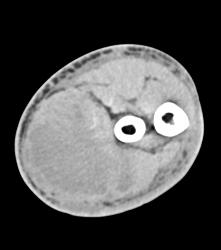 Hematoma in Forearm - CTisus CT Scan