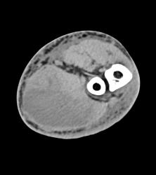 Hematoma in Forearm - CTisus CT Scan