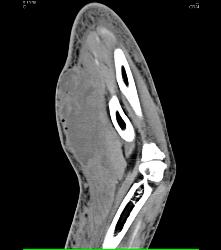 Hematoma in Forearm - CTisus CT Scan