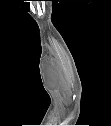 Hematoma in Forearm - CTisus CT Scan