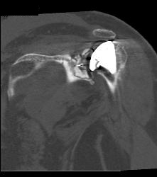 Failed Shoulder Replacement - CTisus CT Scan