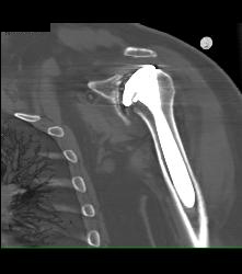 Failed Shoulder Replacement - CTisus CT Scan