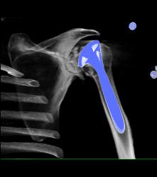 Failed Shoulder Replacement - CTisus CT Scan