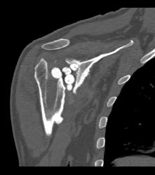 Antibiotics Put in Joint Space Following Prosthesis Removal - CTisus CT Scan