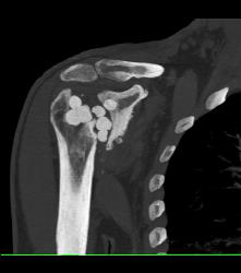 Antibiotics Put in Joint Space Following Prosthesis Removal - CTisus CT Scan