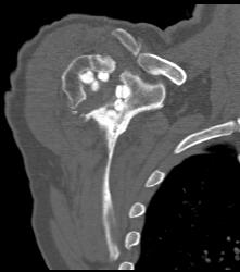 Antibiotics Put in Joint Space Following Prosthesis Removal - CTisus CT Scan