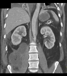 Psoas Abscess - CTisus CT Scan