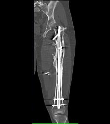 Nonunion With Hardware Present - CTisus CT Scan