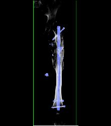 Nonunion With Hardware Present - CTisus CT Scan