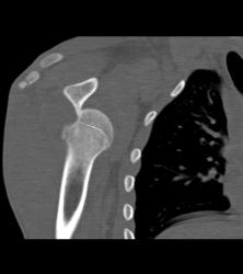 Dislocated Shoulder With Hill-Sachs Deformity - CTisus CT Scan