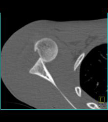 Dislocated Shoulder With Hill-Sachs Deformity - CTisus CT Scan