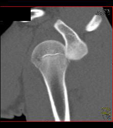 Dislocated Shoulder With Hill-Sachs Deformity - CTisus CT Scan