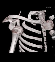 Dislocated Shoulder With Hill-Sachs Deformity - CTisus CT Scan