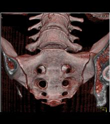 Sacral Foramina in 3D - CTisus CT Scan