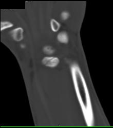 Distal Radius Fracture - CTisus CT Scan