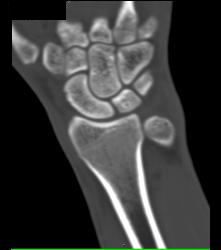 Distal Radius Fracture - CTisus CT Scan