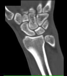 Distal Radius Fracture - CTisus CT Scan