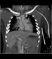 Stab Wound With Intact Left Axillary Artery - CTisus CT Scan