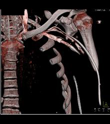 Stab Wound With Intact Left Axillary Artery - CTisus CT Scan