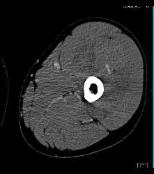 Bleed Thigh - CTisus CT Scan