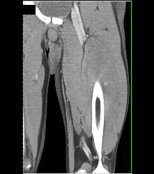 Bleed Thigh - CTisus CT Scan