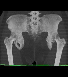 Exstrophy of the Bladder With Deformed Pelvis and Acetabulum - CTisus CT Scan