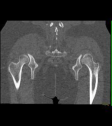 Exstrophy of the Bladder With Deformed Pelvis and Acetabulum - CTisus CT Scan