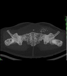 Exstrophy of the Bladder With Deformed Pelvis and Acetabulum - CTisus CT Scan