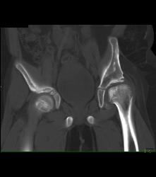 Dysplastic Left Hip - CTisus CT Scan