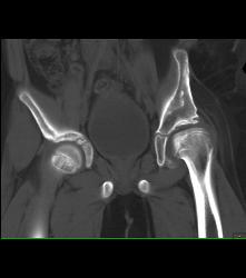 Dysplastic Left Hip - CTisus CT Scan