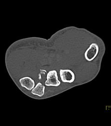 Fracture Dislocation of Carpal/metacarpals, Especially the Base of the Metacarpal - CTisus CT Scan