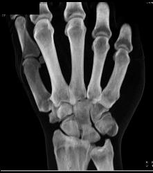 Fracture Dislocation of Carpal/metacarpals, Especially the Base of the Metacarpal - CTisus CT Scan