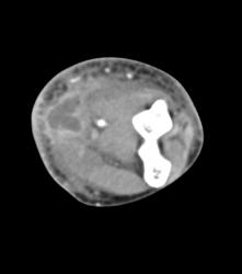 Abscess Elbow - CTisus CT Scan