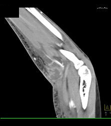 Abscess Elbow - CTisus CT Scan