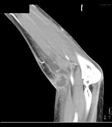 Abscess Elbow - CTisus CT Scan