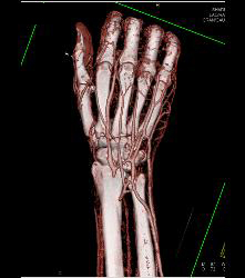 Cellulitis - CTisus CT Scan