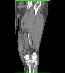 Bleed Thigh S/p Trauma- See Full Sequence - CTisus CT Scan