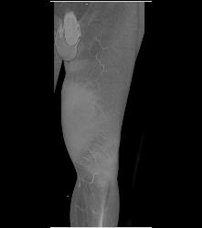 Bleed Thigh S/p Trauma- See Full Sequence - CTisus CT Scan