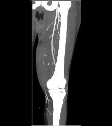 Bleed Thigh S/p Trauma- See Full Sequence - CTisus CT Scan