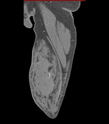 Deformity Humerus With Rotator Cuff Injury - CTisus CT Scan