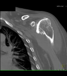 Deformity Humerus With Rotator Cuff Injury - CTisus CT Scan