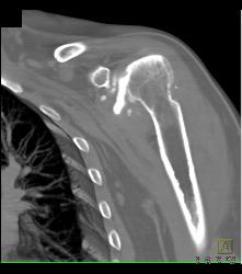 Deformity Humerus With Rotator Cuff Injury - CTisus CT Scan