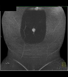 Umbilicus for DIEP Planning - CTisus CT Scan