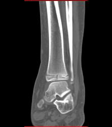 Fracture Through Tibial Epiphyses - CTisus CT Scan