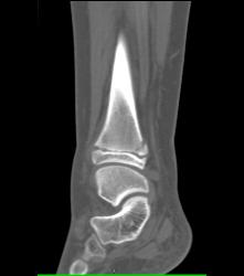 Fracture Through Tibial Epiphyses - CTisus CT Scan