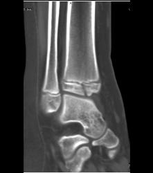 Fracture Through Tibial Epiphyses - CTisus CT Scan