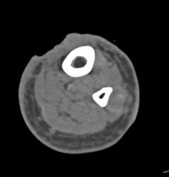 Open Injury to Calf - CTisus CT Scan