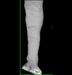 Open Injury to Calf - CTisus CT Scan