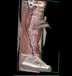 Open Injury to Calf - CTisus CT Scan